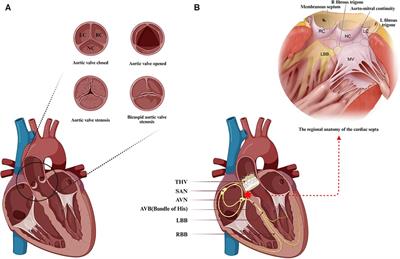 Predictors, clinical impact, and management strategies for conduction abnormalities after transcatheter aortic valve replacement: an updated review